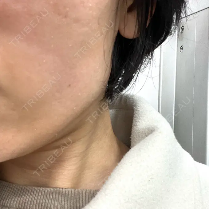 光治療（フォトフェイシャルなど） 銀座TSUBAKIクリニック DAY 6 メイン用