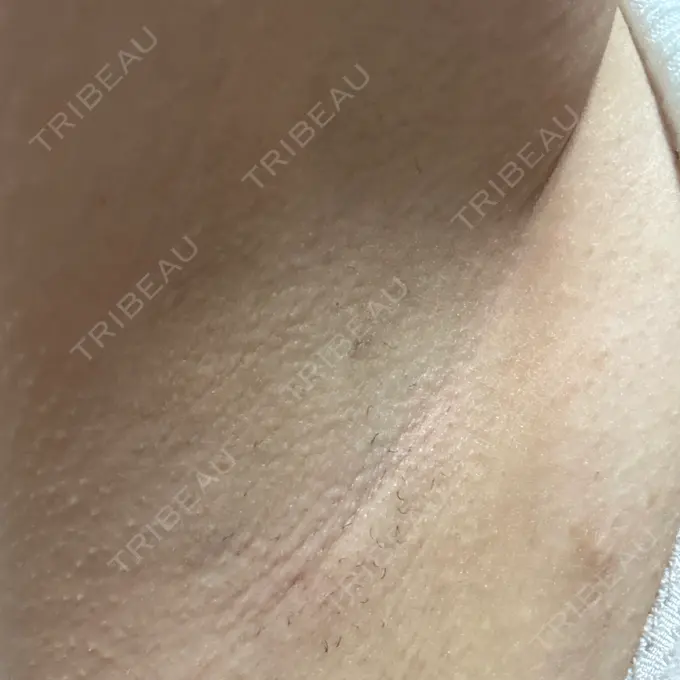 医療脱毛（ワキ） ルラ美容クリニック 神戸院 AFTER メイン用