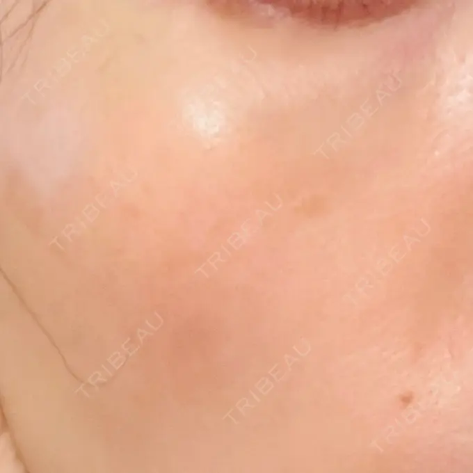 LDM・インテンスウルトラ 品川スキンクリニック広島院 DAY 7 メイン用