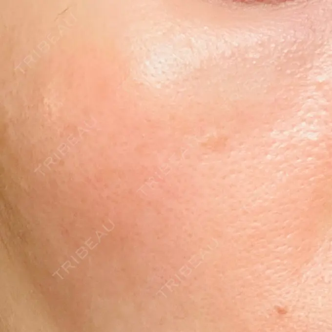 LDM・インテンスウルトラ 品川スキンクリニック広島院 DAY 8 メイン用