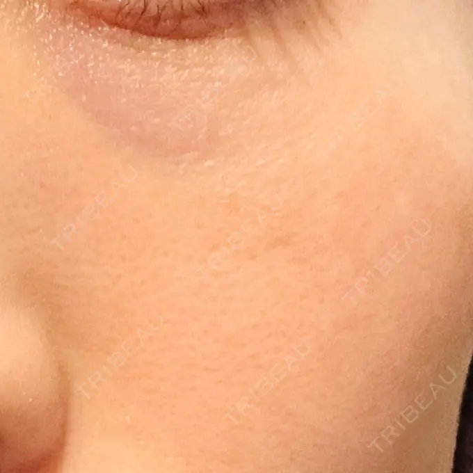 RF（高周波）たるみ治療 湘南美容クリニック 広島院 DAY 2 メイン用