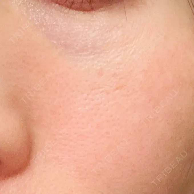 RF（高周波）たるみ治療 湘南美容クリニック 広島院 DAY 3 メイン用