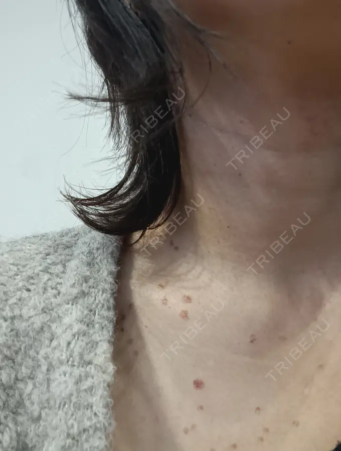 シミ取りレーザー / インモード 東京シルククリニック 新宿院 DAY 3 メイン用