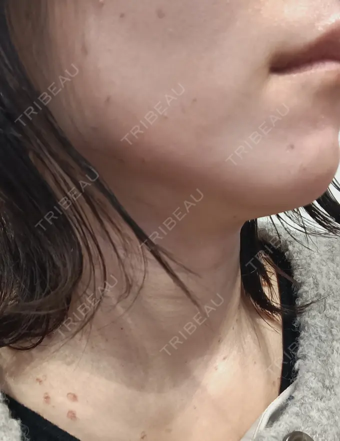 シミ取りレーザー / インモード 東京シルククリニック 新宿院 DAY 3 メイン用