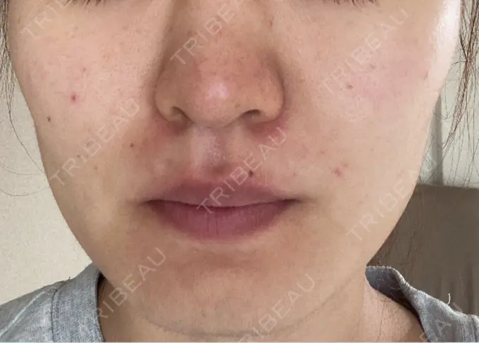 ボトックス（エラ・小顔） 共立美容外科 梅田院 AFTER メイン用