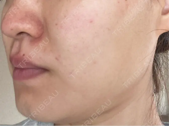 ボトックス（エラ・小顔） 共立美容外科 梅田院 DAY 17 メイン用