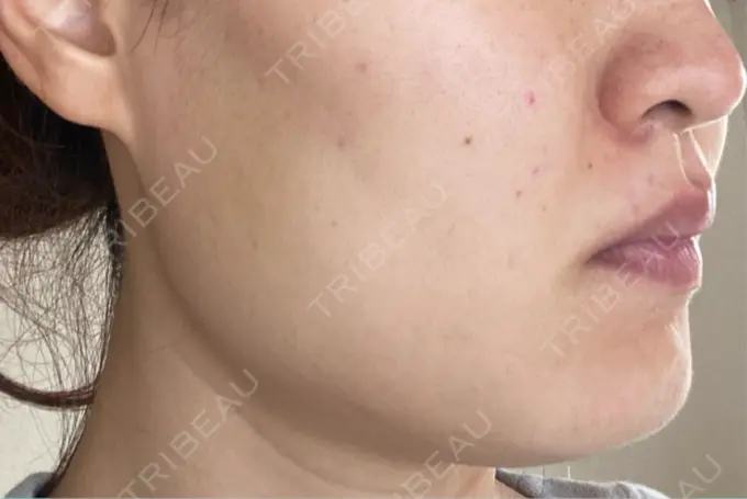 ボトックス（エラ・小顔） 共立美容外科 梅田院 DAY 17 メイン用