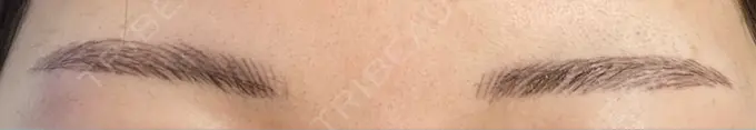 アートメイク（眉） 平和台皮フ科 DAY 6 メイン用
