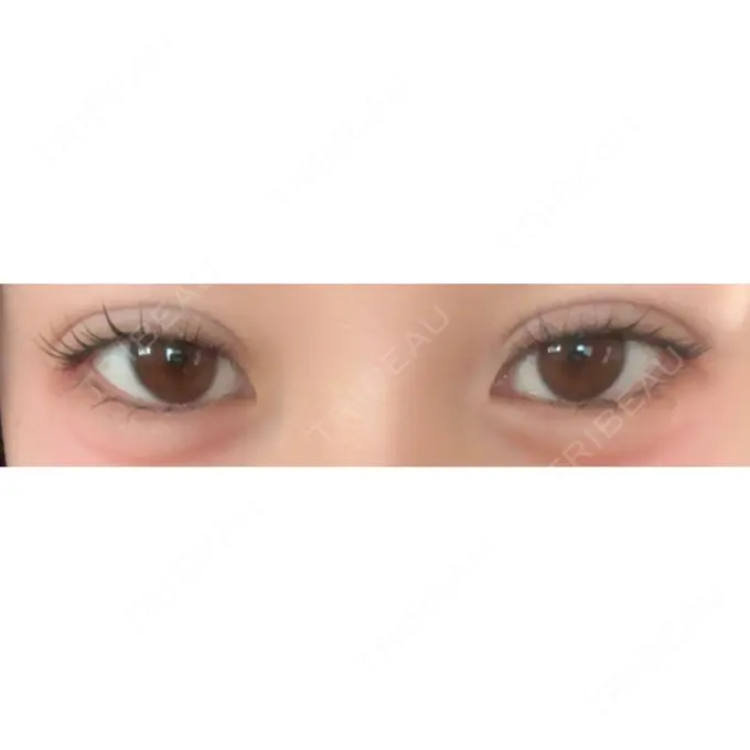 二重埋没 アリエル美容クリニック 水戸院 DAY 4 メイン用