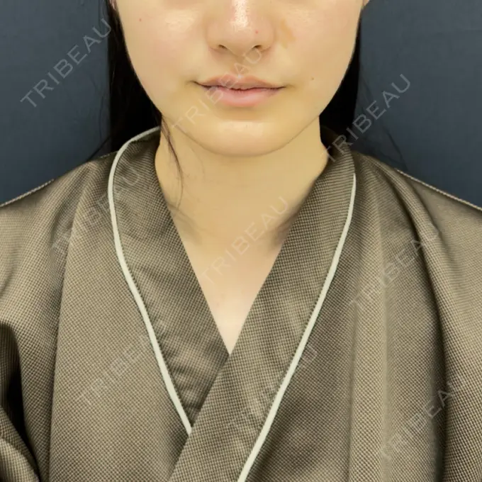 糸リフト / 脂肪吸引（顔） / ジョールファット除去 / ボトックス（エラ・小顔） RIVER CLINIC（リバークリニック） AFTER メイン用