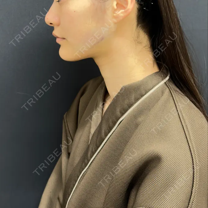 糸リフト / 脂肪吸引（顔） / ジョールファット除去 / ボトックス（エラ・小顔） RIVER CLINIC（リバークリニック） DAY 0 メイン用