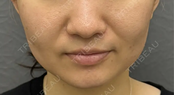 小鼻縮小（切開） 渋谷の森クリニック AFTER メイン用