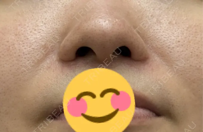 小鼻縮小（切開） 渋谷の森クリニック DAY 98 メイン用