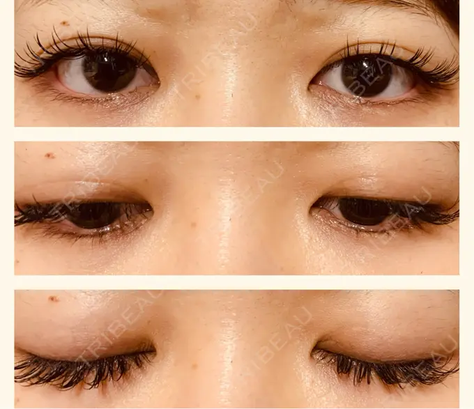 二重埋没 水の森美容クリニック 東京銀座院 AFTER メイン用