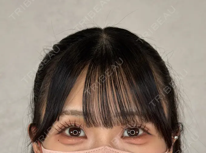 二重埋没 アリエル美容クリニック 横浜院 AFTER メイン用