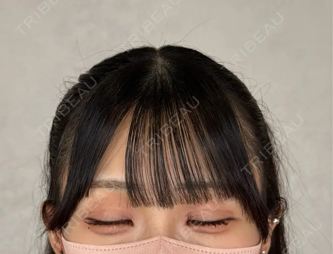 二重埋没 アリエル美容クリニック 横浜院 DAY 37 メイン用