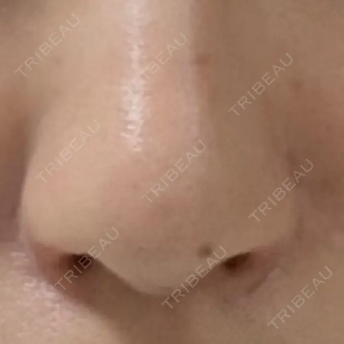 鼻孔縁挙上 シエルクリニック AFTER メイン用