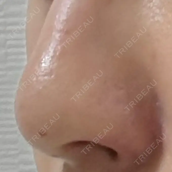 鼻孔縁挙上 シエルクリニック DAY 34 メイン用