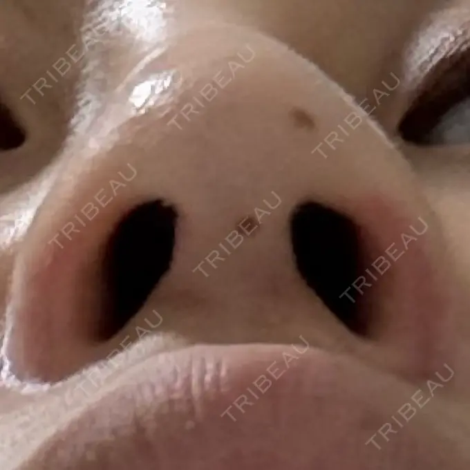 鼻孔縁挙上 シエルクリニック DAY 34 メイン用