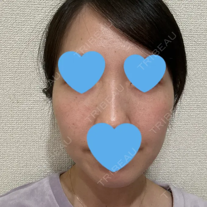 ピーリング（ニキビ・毛穴） 共立美容外科 千葉院 AFTER メイン用