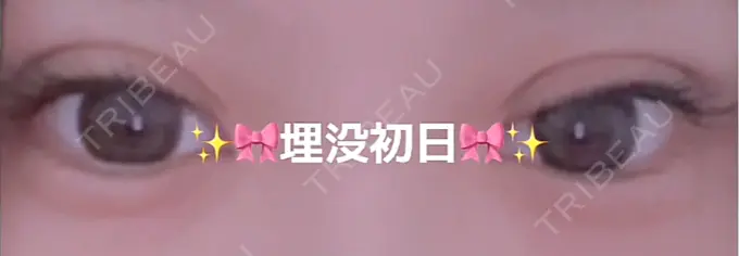 二重埋没 TCB東京中央美容外科 大分院 AFTER メイン用