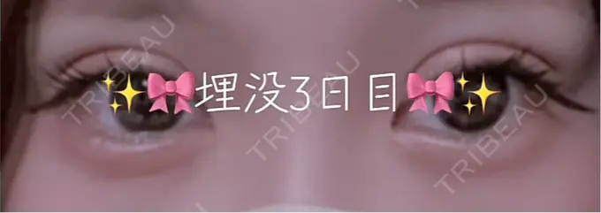 二重埋没 TCB東京中央美容外科 大分院 DAY 0 メイン用