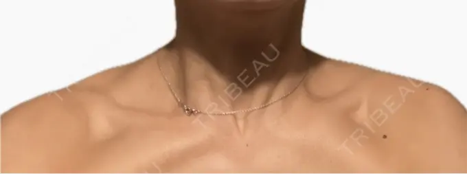 ボトックス（肩） / ボトックス（首） アールクリニック DAY 1 メイン用