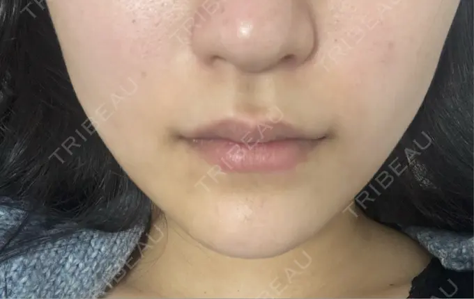 RF（高周波）たるみ治療 / オンダリフト ライブリークリニック 大阪院 AFTER メイン用