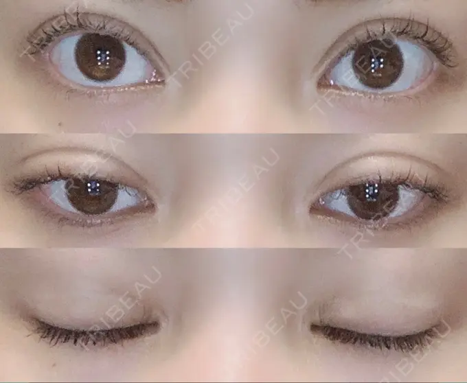 二重切開 / 目頭切開 湘南美容クリニック 池袋西口院 DAY 319 メイン用