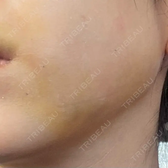 糸リフト / 脂肪吸引（顔） / ジョールファット除去 / ヒアルロン酸注入（あご） 新宿美容外科ネビュラクリニック DAY 1 メイン用