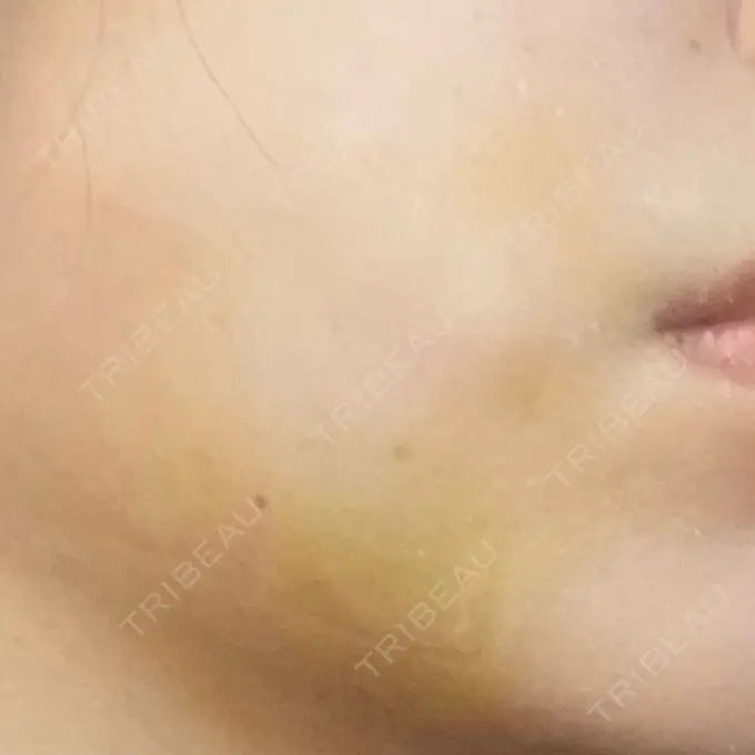 糸リフト / 脂肪吸引（顔） / ジョールファット除去 / ヒアルロン酸注入（あご） 新宿美容外科ネビュラクリニック DAY 1 メイン用