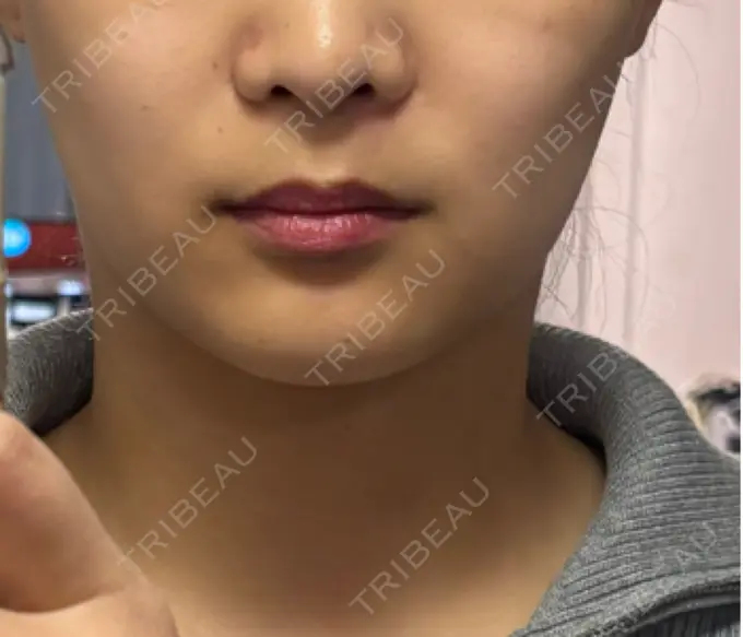 ハイフ（顔） 東京美容外科 福岡院 AFTER メイン用