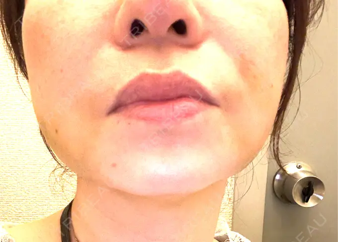 糸リフト / バッカルファット除去 / 脂肪吸引（顔） / 脂肪吸引注射（顔） 東京シンデレラ美容外科 池袋院 DAY 6 メイン用