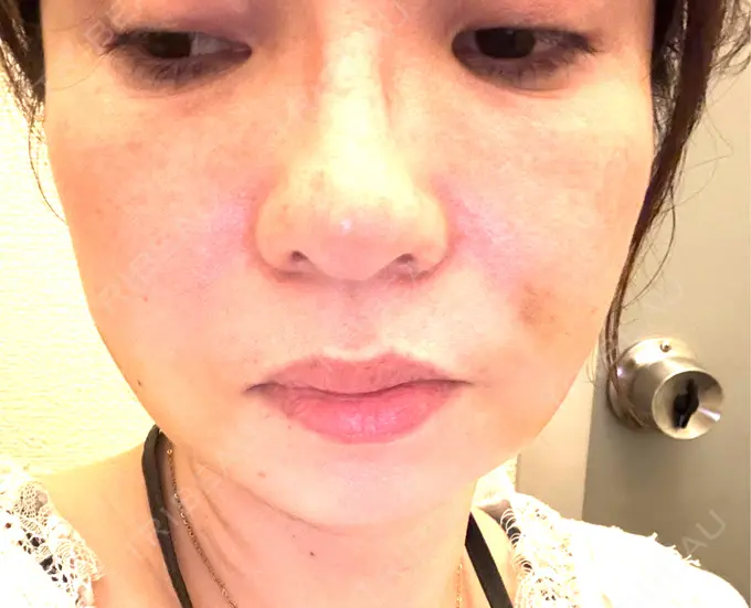 糸リフト / バッカルファット除去 / 脂肪吸引（顔） / 脂肪吸引注射（顔） 東京シンデレラ美容外科 池袋院 DAY 6 メイン用