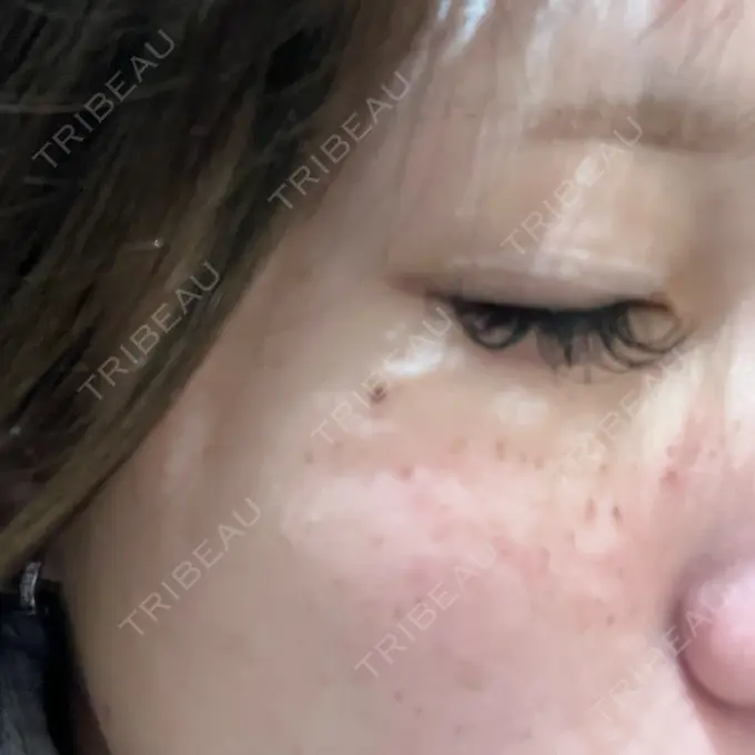 ルメッカ 大美会クリニック 心斎橋本院 DAY 0 メイン用