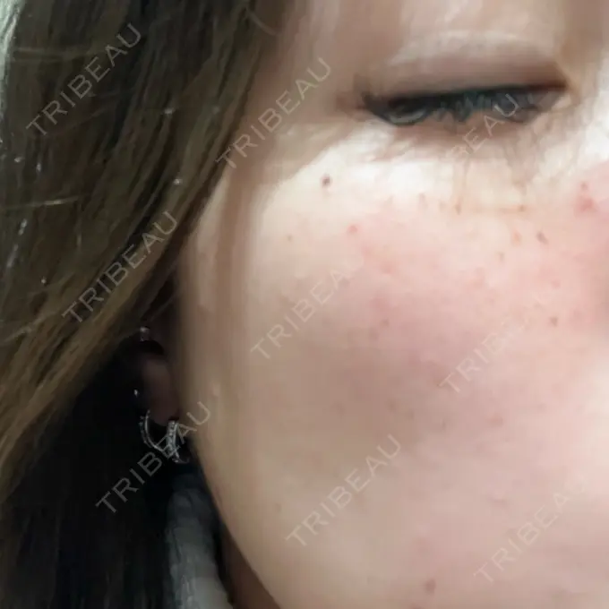 ルメッカ 大美会クリニック 心斎橋本院 DAY 0 メイン用