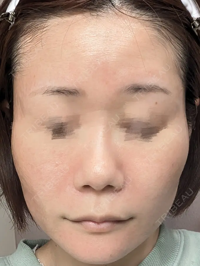 水光注射（ハリ・美肌） / ピーリング（ニキビ・毛穴） / ピーリング（ハリ・ツヤ） DAILY SKIN CLINIC 心斎橋院 DAY 7 メイン用