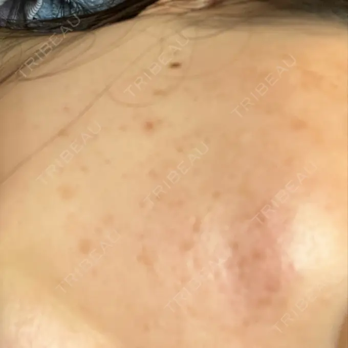 フラクショナルレーザー（毛穴・ニキビ跡） Designo Clinic （デジーノクリニック） DAY 2 メイン用