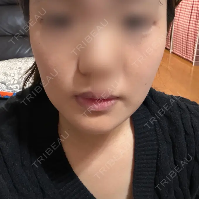 ヒアルロン酸注入（涙袋） / ボトックス（エラ・小顔） / ヒアルロン酸注入（唇） アリエル美容クリニック 横浜院 AFTER メイン用