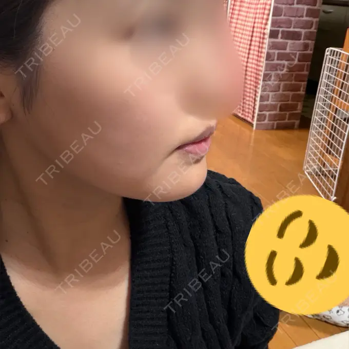 ヒアルロン酸注入（涙袋） / ボトックス（エラ・小顔） / ヒアルロン酸注入（唇） アリエル美容クリニック 横浜院 DAY 97 メイン用