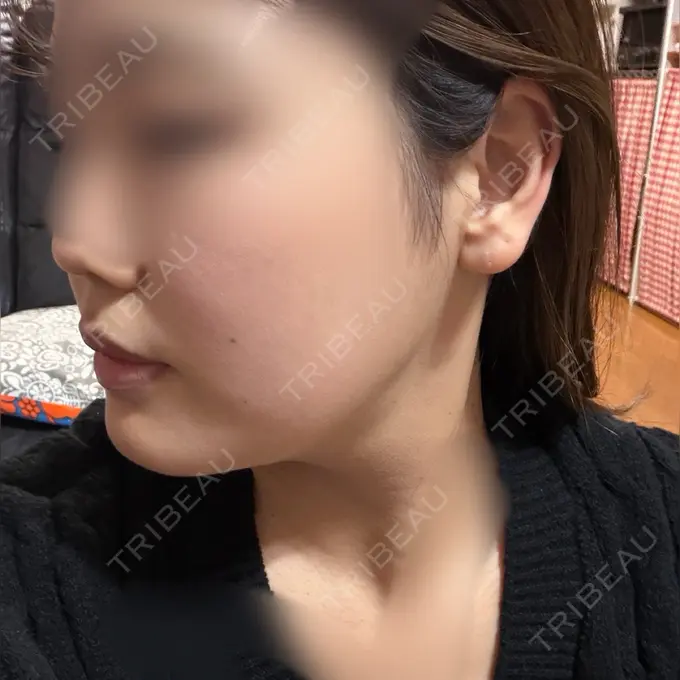 ヒアルロン酸注入（涙袋） / ボトックス（エラ・小顔） / ヒアルロン酸注入（唇） アリエル美容クリニック 横浜院 DAY 97 メイン用