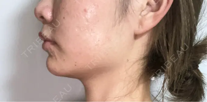 ボトックス（エラ・小顔） TCB東京中央美容外科 那覇院 AFTER メイン用