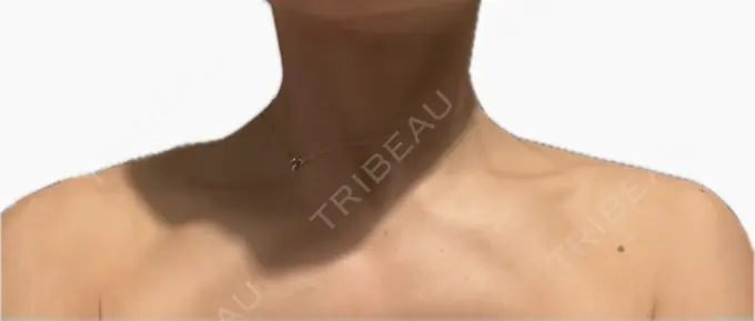 ボトックス（肩） / ボトックス（首） アールクリニック DAY 2 メイン用