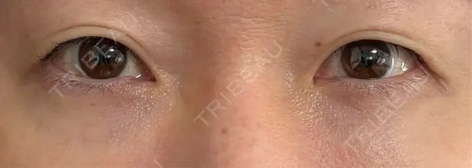 クマ治療 eクリニック 横浜みなとみらい院 AFTER メイン用