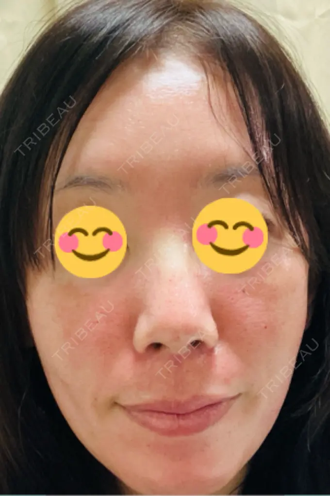 ポテンツァ ルラ美容クリニック 千葉院 / ルラスキンクリニック 千葉院 AFTER メイン用