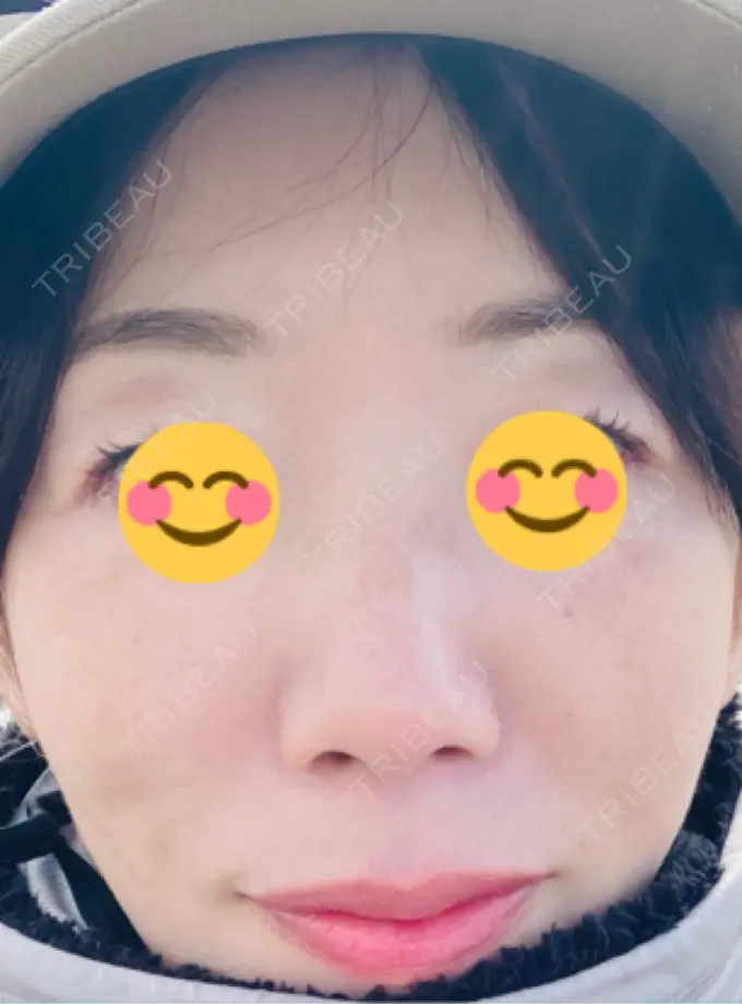 ポテンツァ ルラ美容クリニック 千葉院 / ルラスキンクリニック 千葉院 DAY 0 メイン用