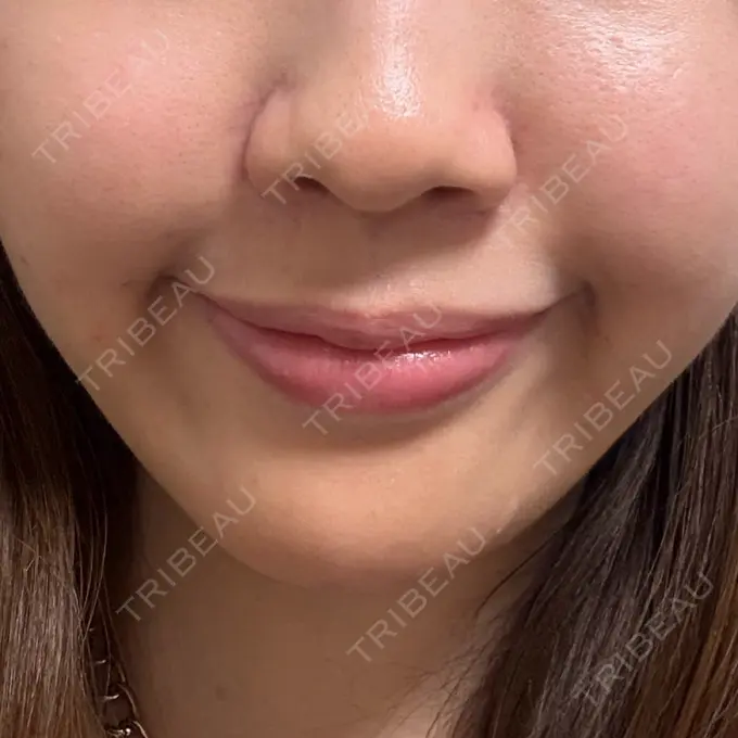 脂肪溶解注射（顔） 日比谷セントラルクリニック DAY 0 メイン用