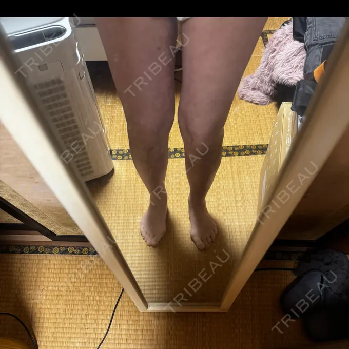 脂肪溶解注射（太もも） HAAB×DREAM BEAUTY CLINIC 東京本院 DAY 63 メイン用