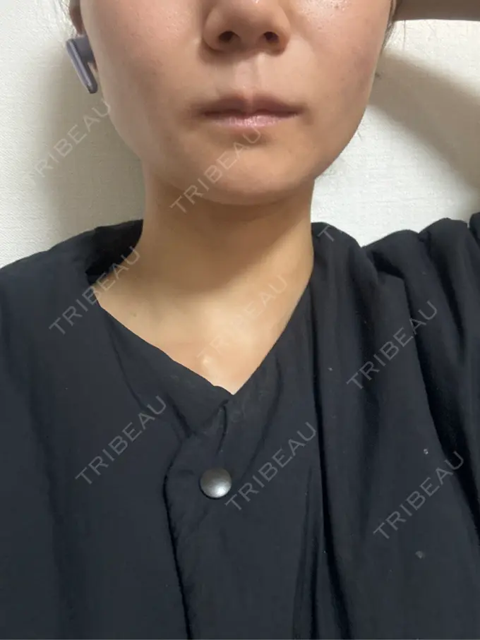 ボトックス（エラ・小顔） / ボトックス（肩） / ボトックス（眉間） / ボトックス（目尻） / ボトックス（額） / ボトックス（首） / ボトックス（人中） / ボトックス（バニーライン） DMTC CLINIC 日本橋院 AFTER メイン用