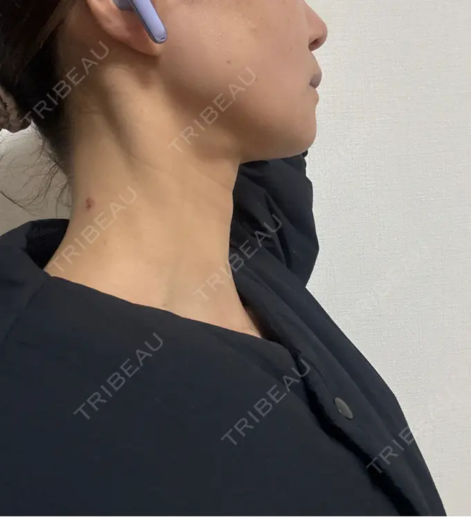 ボトックス（エラ・小顔） / ボトックス（肩） / ボトックス（眉間） / ボトックス（目尻） / ボトックス（額） / ボトックス（首） / ボトックス（人中） / ボトックス（バニーライン） DMTC CLINIC 日本橋院 DAY 27 メイン用